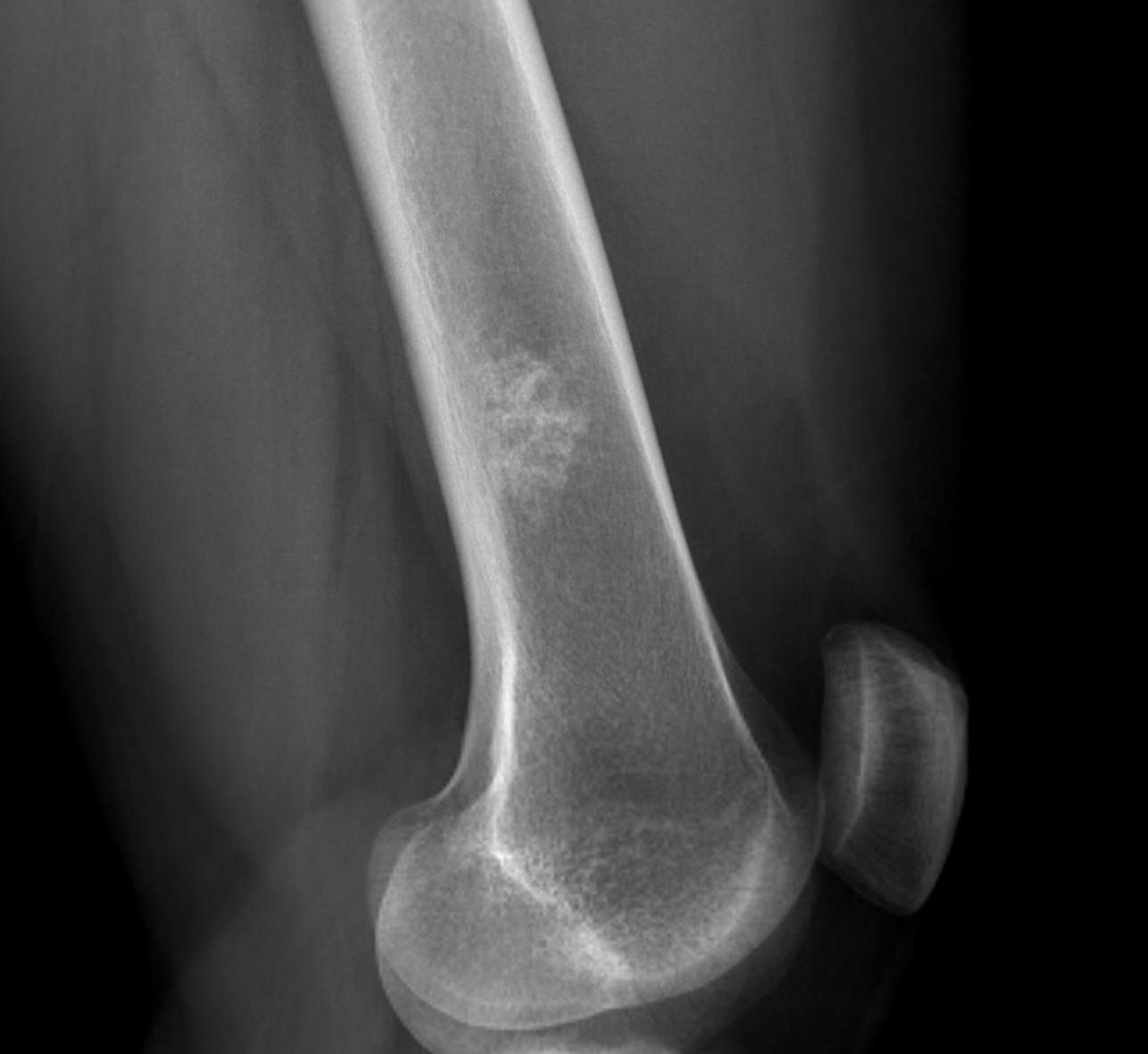 Enchondroma Distal Femur0002